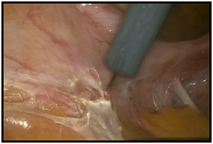 Jplasma surg energies Bovie