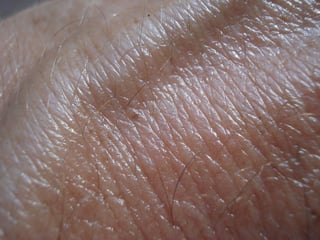 non-melanoma skin cancer
